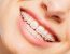 What to Do If Your Braces Break or Get Damaged
